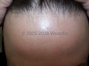 Clinical image of Frontal fibrosing alopecia - imageId=4055699. Click to open in gallery.  caption: 'A band of scarring alopecia at the anterior scalp line with few remaining hairs in scarred areas (the "lonely hair" sign). There is significant perifollicular scale and some erythema on the scalp posterior to this band.'