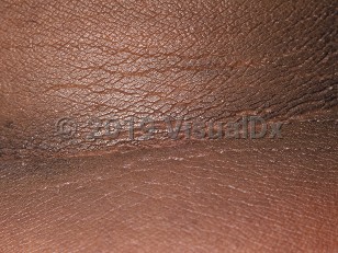 Clinical image of Acanthosis nigricans - imageId=40959. Click to open in gallery.  caption: 'Acanthotic, thickened, ridged, and hyperpigmented plaques on the posterior neck.'