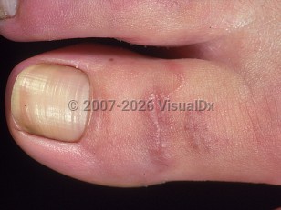 Cutaneous larva migrans