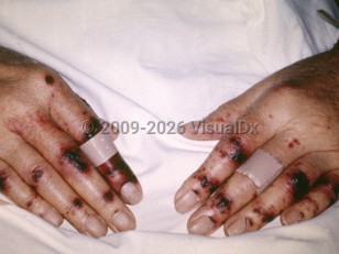 Thrombotic thrombocytopenic purpura