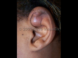 Clinical image of Pseudocyst of auricle - imageId=4152931. Click to open in gallery.  caption: 'A reddish bosselated nodule of the ear.'