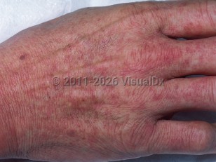 Mononucleosis