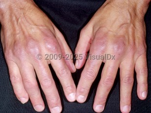 Clinical image of Rheumatoid arthritis - imageId=4267555. Click to open in gallery.  caption: 'Violaceous patches over the Metacarpophalangeals (MCP) and dorsal fingers in a patient with morphea. '