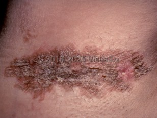 Clinical image of Granular parakeratosis - imageId=4468158. Click to open in gallery.  caption: 'A brownish plaque with brown keratotic projections in the axilla.'