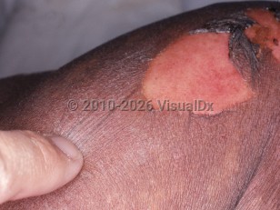 Clinical image of Toxic epidermal necrolysis - imageId=4531199. Click to open in gallery.  caption: 'A close-up of denuded erosions with adjacent peeling and detached necrotic epidermis secondary to an anticonvulsant.'