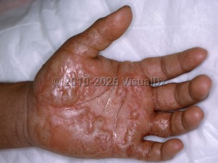 Ammonia and sulfur dioxide burns