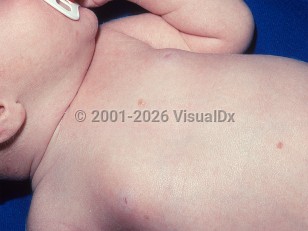 Clinical image of Congenital self-healing reticulohistiocytosis - imageId=458167. Click to open in gallery.  caption: 'Two pinkish papules on the trunk of an infant.'
