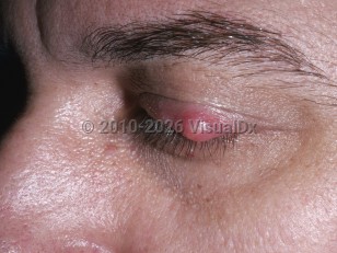 Hordeolum and chalazion