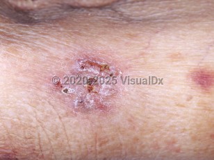 Clinical image of Alternariosis - imageId=4773799. Click to open in gallery.  caption: 'A close-up of a crusted and scaly plaque in a patient with CLL.'