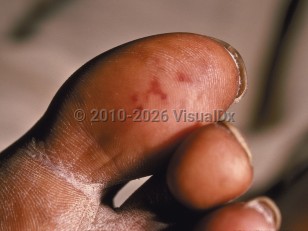Endocarditis