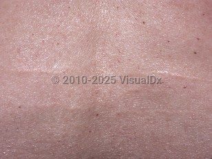 Clinical image of Linear focal elastosis - imageId=4790796. Click to open in gallery.  caption: 'A close-up of linear, yellow, striae-like plaques on the back.'