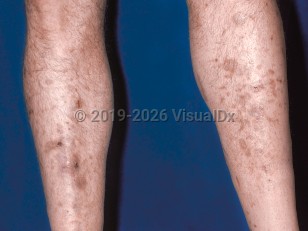 Clinical image of Diabetic dermopathy - imageId=47971. Click to open in gallery.  caption: 'Reddish-brown macules and patches, atrophic whitish plaques, and scattered crusts on the shins.'