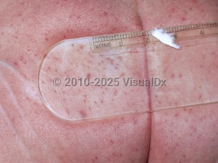 Clinical image of Newborn thrombocytopenic purpura - imageId=4854242. Click to open in gallery.  caption: 'Diffuse petechiae and purpura on the buttocks.'