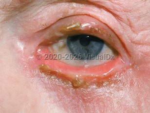 Clinical image of Ectropion - imageId=486876. Click to open in gallery.  caption: 'Eversion of the inferior lid and erosion and crusting of both lid margins.'
