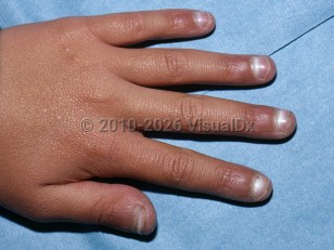 Clinical image of Tetralogy of Fallot - imageId=5055331. Click to open in gallery.  caption: '<span>White lunulae in a patient with Tetralogy of Fallot.</span>'