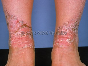Acquired acrodermatitis enteropathica
