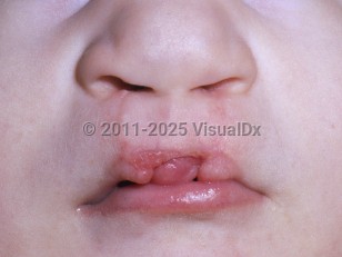 Clinical image of Trisomy 13 syndrome - imageId=5272050. Click to open in gallery.  caption: 'Cleft lip.'