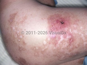 Clinical image of Leprosy-Lucio phenomenon - imageId=5291837. Click to open in gallery.  caption: 'An erythematous plaque with an overlying eschar and surrounding depigmented plaques with light brown haloes on the lateral thigh and buttock.'