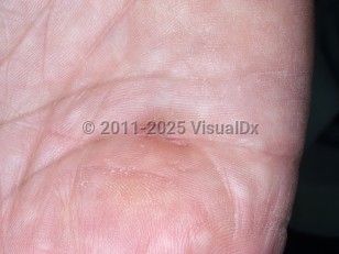 Clinical image of Dupuytren disease - imageId=5311536. Click to open in gallery.  caption: 'A horizontal depression flanked by fibrotic bands on the palm.'