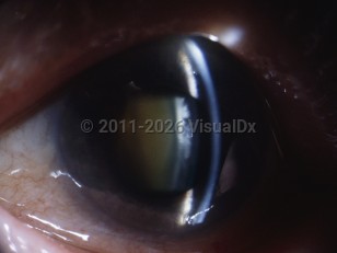 Acute angle-closure glaucoma