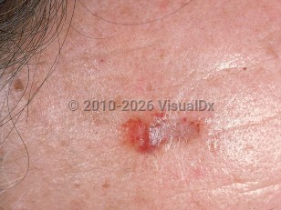 Clinical image of Nodular amyloidosis - imageId=538039. Click to open in gallery.  caption: 'A purpuric plaque with a scarred area on the forehead.'