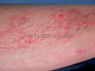 Clinical image of Angioma serpiginosum - imageId=541631. Click to open in gallery.  caption: 'Multiple erythematous and telangiectatic macules, papules and plaques on the lower leg.'