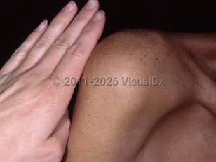 Clinical image of Hemochromatosis - imageId=5420735. Click to open in gallery.  caption: 'Diffuse bronze discoloration of the skin.'