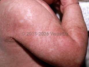Clinical image of Multiple carboxylase deficiency - imageId=5460992. Click to open in gallery.  caption: 'Diffuse erythematous papules and plaques with overlying peeling and thin crusts on the arm and lateral chest.'