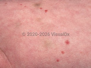Clinical image of Hermansky-Pudlak syndrome - imageId=572638. Click to open in gallery.  caption: 'Pink papules (nevi), ecchymoses, and background dilution of skin color on the chest.'