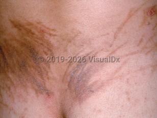 Clinical image of Drug-induced flagellate pigmentation - imageId=598666. Click to open in gallery.  caption: 'A close-up of flagellate brown plaques on the lower back, some scaly, secondary to bleomycin.'