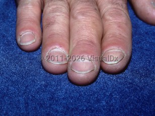 Clinical image of Thoracic outlet syndrome - imageId=5990400. Click to open in gallery.  caption: '<span>Koilonychia secondary to thoracic outlet syndrome.</span>'