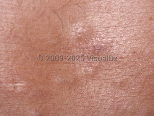 Clinical image of Eruptive vellus hair cyst - imageId=60528. Click to open in gallery.  caption: 'A close-up of several skincolored papules with tiny central puncta.'