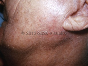 Clinical image of Parotitis - imageId=6175609. Click to open in gallery.  caption: 'A faint pink mass at the inferior earlobe.'