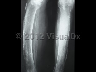 Imaging Studies image of Periostitis - imageId=6183988. Click to open in gallery. 