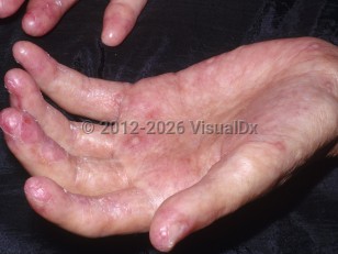 Chronic graft-versus-host disease