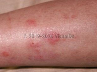 Clinical image of Cytomegalovirus infection - imageId=64333. Click to open in gallery.  caption: 'Erythematous, edematous papules and plaques on the leg with scattered overlying crusts.'