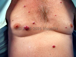 Clinical image of POEMS syndrome - imageId=6555944. Click to open in gallery.  caption: 'Smooth red papules and nodules scattered on the anterior trunk.'