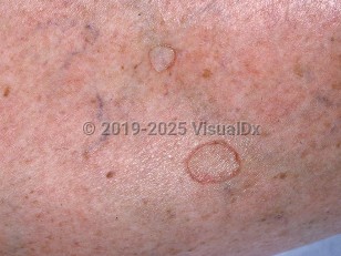Clinical image of Disseminated superficial actinic porokeratosis - imageId=662415. Click to open in gallery.  caption: 'A close-up of a flat, annular papule and a similar plaque, each with a peripheral hyperkeratotic, ridge-like scale.'