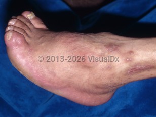 Poliomyelitis