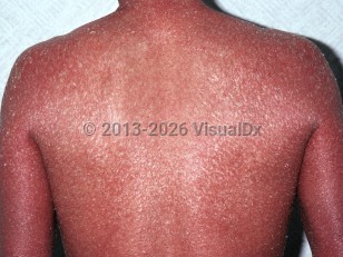 Clinical image of Nonbullous congenital ichthyosiform erythroderma - imageId=6750272. Click to open in gallery.  caption: 'Erythroderma secondary to non-bullous ichthyosiform erythroderma, showing diffuse deep red erythema and scaling on the back and arms.'