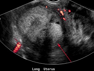 Imaging Studies image of Endometrial carcinoma - imageId=6841123. Click to open in gallery.  caption: '<span>Sagittal color Doppler image of uterus with complex mass, with no internal vascularity, pathology-proven endometrial sarcoma.<br /></span>'