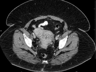 Uterine fibroids