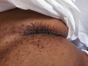 Clinical image of Galli-Galli disease - imageId=6846206. Click to open in gallery.  caption: 'Discrete and reticulated, brown macules and plaques on the breast and upper abdomen.'