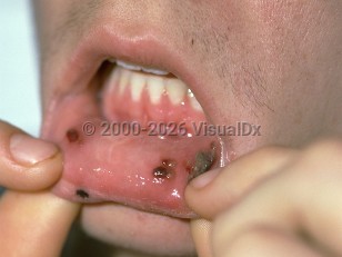 Oral leukemic infiltration