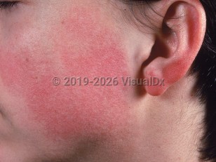 Clinical image of Keratosis pilaris atrophicans faciei - imageId=692642. Click to open in gallery.  caption: 'Marked erythema of the cheek and ear with follicular prominence on the cheek.'