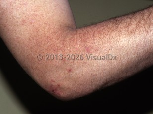 Clinical image of Brachioradial pruritus - imageId=7058582. Click to open in gallery.  caption: 'Crusted papules on the forearm near the elbow.'