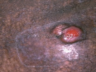 Lymphoma