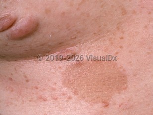 Clinical image of Neurofibromatosis - imageId=742400. Click to open in gallery.  caption: 'A close-up of pinkish and brownish papules and nodules (neurofibromas) and light brown patches (confetti and <span>caf&eacute; au lait </span> macules).'