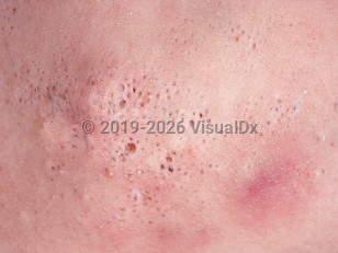 Clinical image of Nevus comedonicus - imageId=753599. Click to open in gallery.  caption: 'A close-up of groups of comedone-like pits of varying sizes and some tiny white papules.'