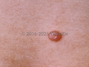 Clinical image of Molluscum contagiosum (pediatric) - imageId=76426. Click to open in gallery.  caption: 'A close-up of a pink umbilicated papule.'